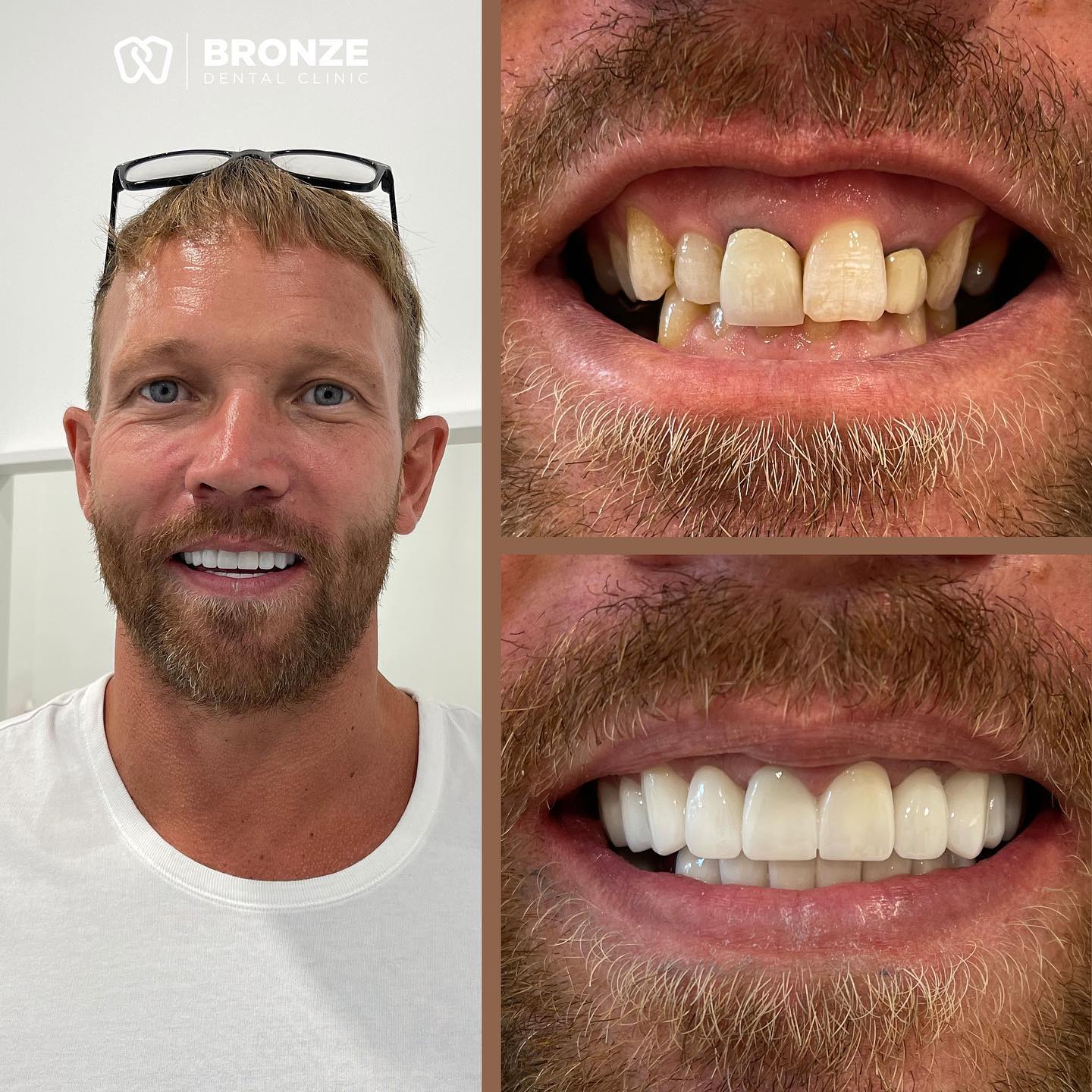 before after image