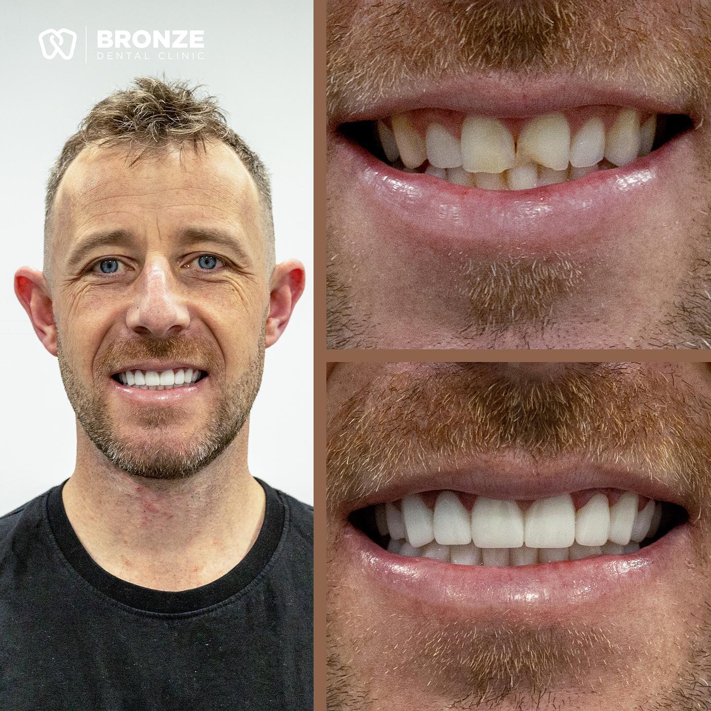  before after image