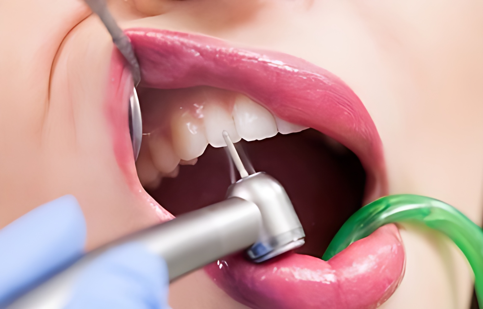 What-is-the-most-effective-way-to-treat-cavities-antalya-turkey