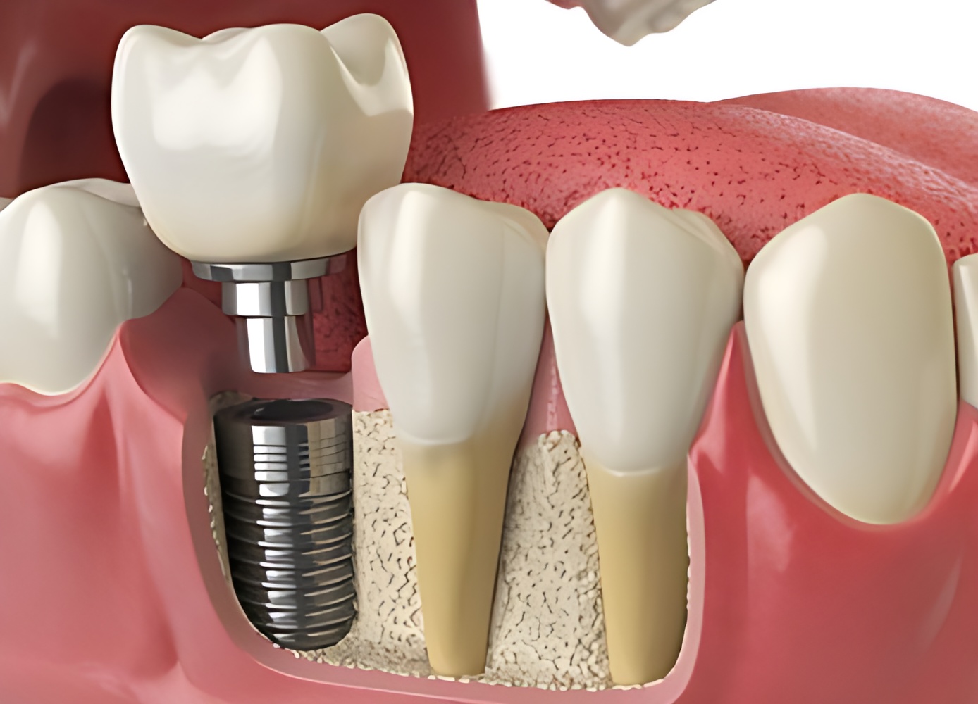 Are dental implants safe for everyone-What are dental implants?-Dental Clinic Antalya Turkey