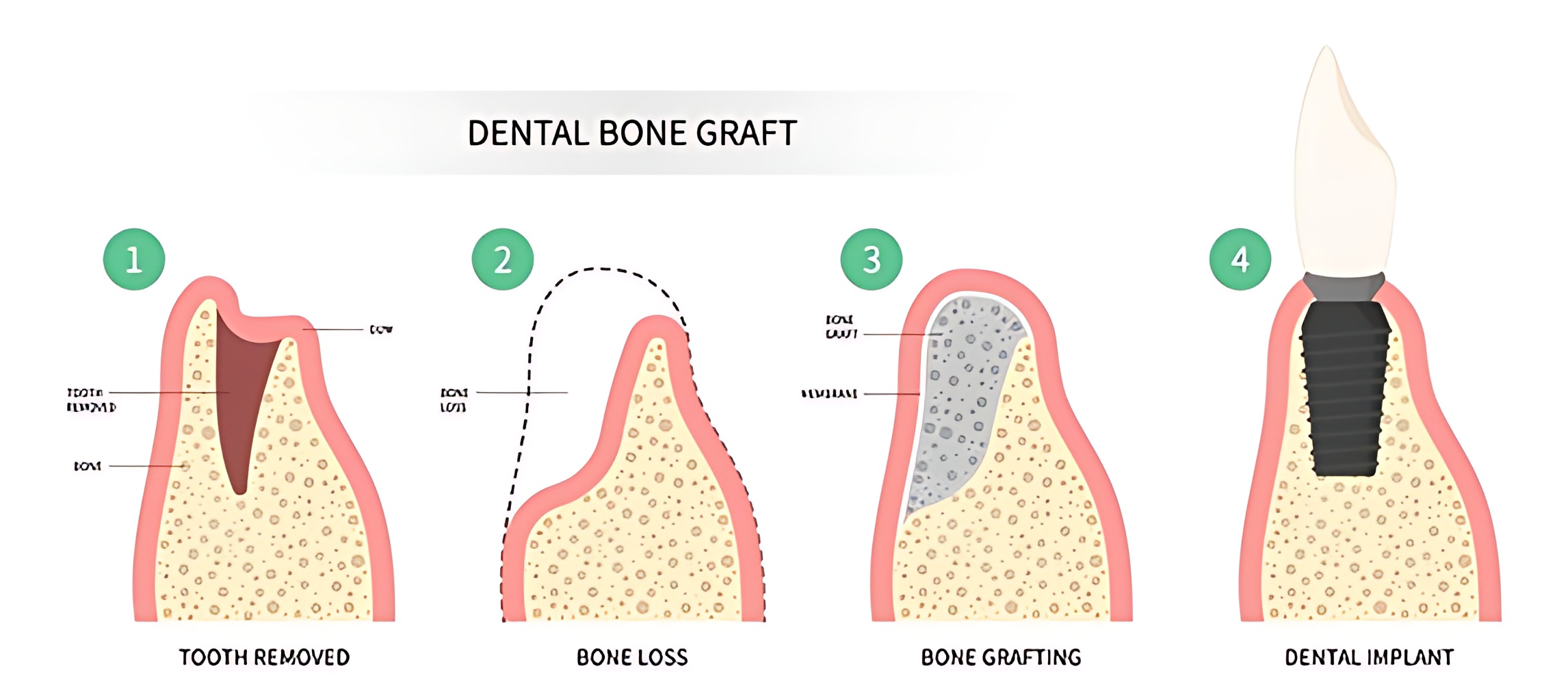 Are dental implants possible for everyone?-Dental Clinic Antalya Turkey